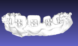 Bracket Removal - BEFORE