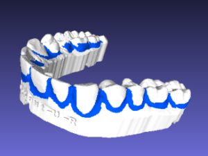 Retainer with user-defined blockout