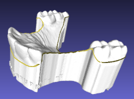 Theroux Retainer cut out assistance